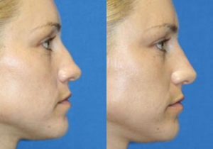 nose reshaping