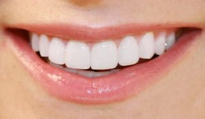 Dental Veneers – Learn What They Are & What They Do