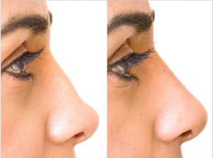 Pros and Cons Of Nose Reshaping