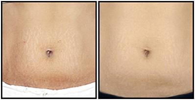 Stretch Marks Removal Ideas That Work