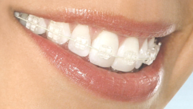 Types Of Braces - Which Is Right For You